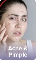 Vitiligo depigmentation patches on skin showing loss of color and pigmentation